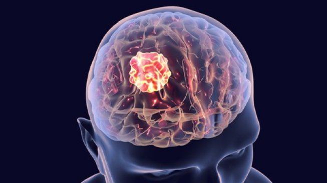 Ilustrasi kanker atau tumor otak. (Shutterstock)
