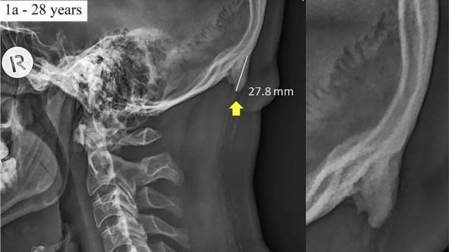 Tumbuh tanduk di belakang kepala karena keseringan main ponsel bukan sesuatu hal yang serius. (Dok. Jurnal Scientific Reports/David Shahar)