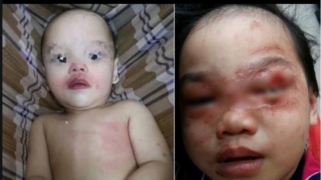 Kondisi dua anak terkena gigitan semut charlie (Facebook/ASYIKfm)