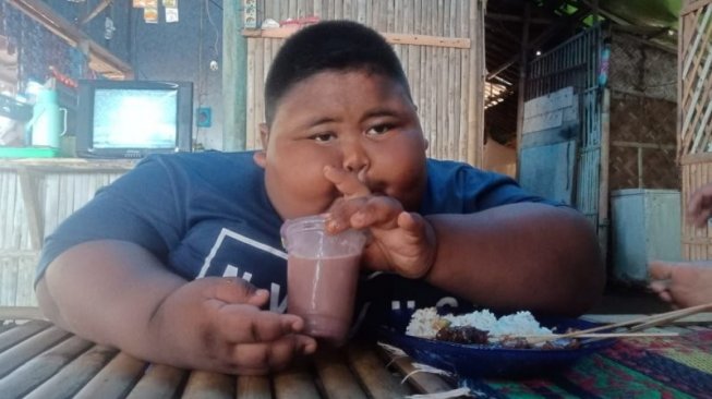 Satia Putra, bocah obesitas ekstrem dari Karawang. (Dok. ANTARA)