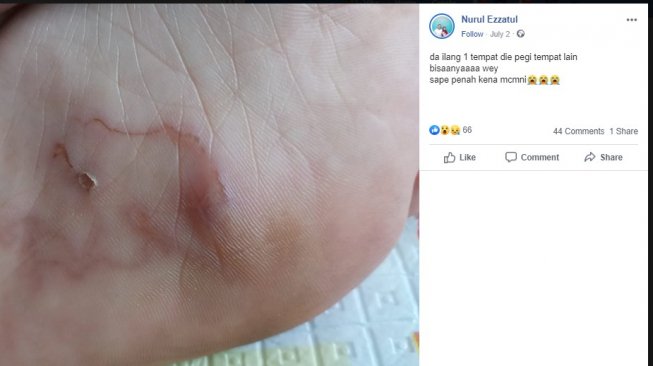 Seorang wanita kena infeksi cacing di kakinya. (Facebook.com/Nurul Ezzatul)