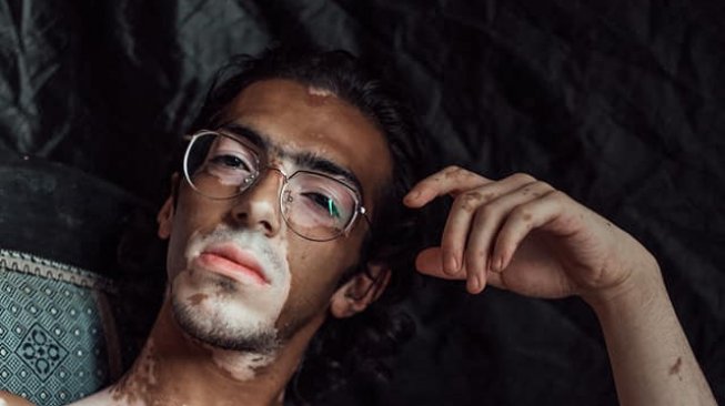 Dulu Dihina Mirip Sapi, Pria Vitiligo Ini Sekarang Jadi Model Terkenal