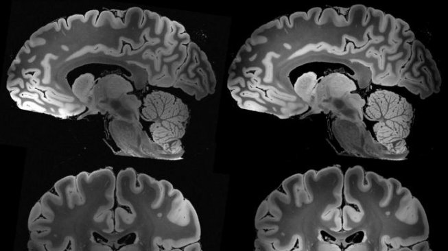 Tampilan otak secara mendetail melalui MRI teknologi baru. (Jurnal Biorxiv/ Brian L. Edlow)