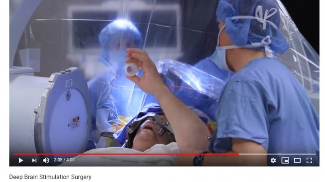 Ilustrasi operasi stimulasi otak dalam (YouTube/Northwestern Medicine)