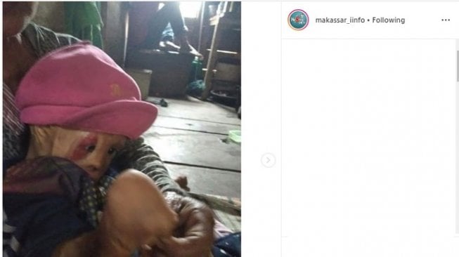 Alami Luka Bakar Saat Usia 6 Bulan, Begini Kisah Pilu Gadis 7 Tahun Ini