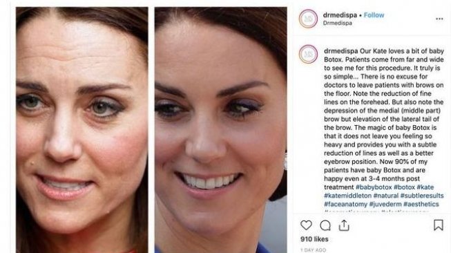 Kate Middleton diduga pakai botox [ig @huffpost]