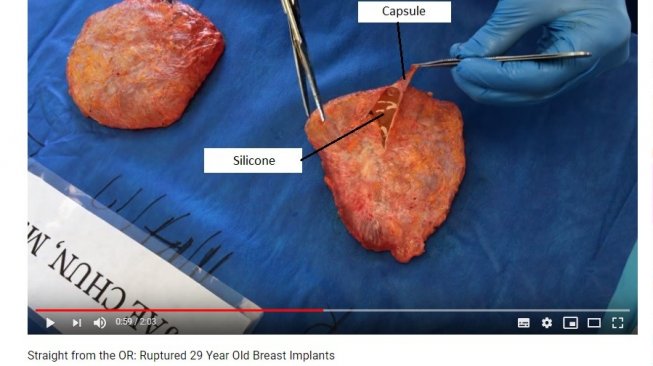 Tampilan implan payudara setelah diangkat (YouTube/Dr. Jae Chun, MD)