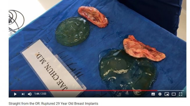 Tampilan implan payudara setelah diangkat (YouTube/Dr. Jae Chun, MD)