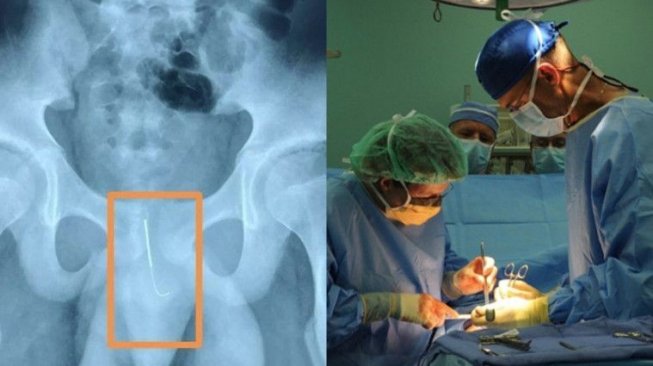 Supaya Semangat Mengerjakan PR, Anak Ini Tusukan Jarum  di Organ Intimnya!