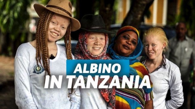 Kisah Tragis Orang Albino di Tanzania yang Dianggap Bak Titisan Iblis