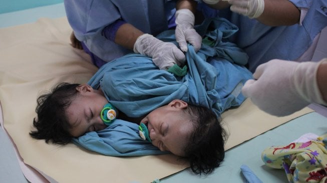 Aqila dan Azila kembar siam asal Kendari, Sulawesi Tenggara di Instalansi Rawat Inap (Irna) anak RSUD Dr Soetomo Surabaya, Jawa Timur, Rabu (14/8). [ANTARA FOTO/Didik Suhartono]