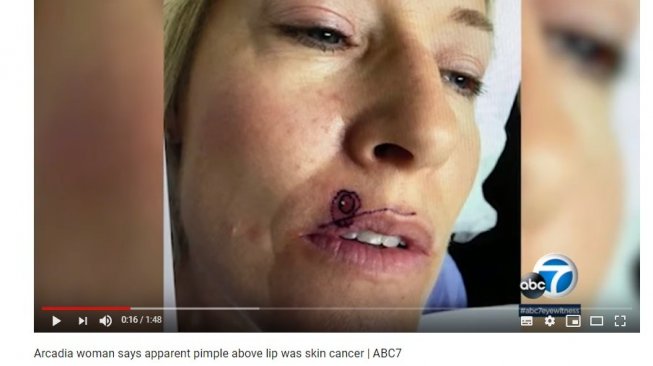Jerawat yang ternyata kanker kulit (YouTube/ABC7)