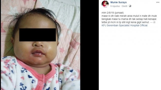 Gejala awal infeksi kulit pada bayi 5 bulan (Facebook/Munie Suraya)