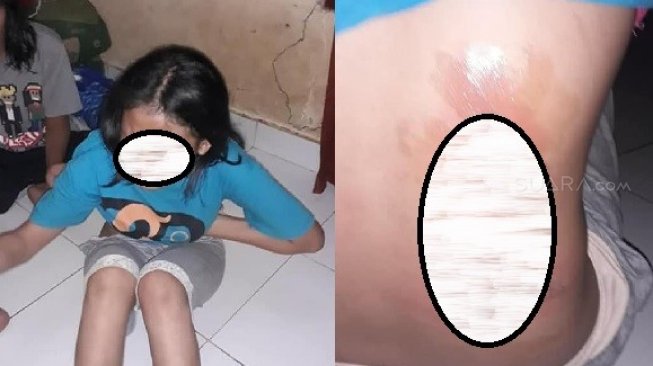 Telat Pulang Sekolah, Siswi SMK Diseterika Bibinya hingga Melepuh