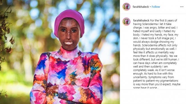 Kisah insipiratif Farah Khaleck, penderita scleroderma (Instagram/@farahkhaleck)