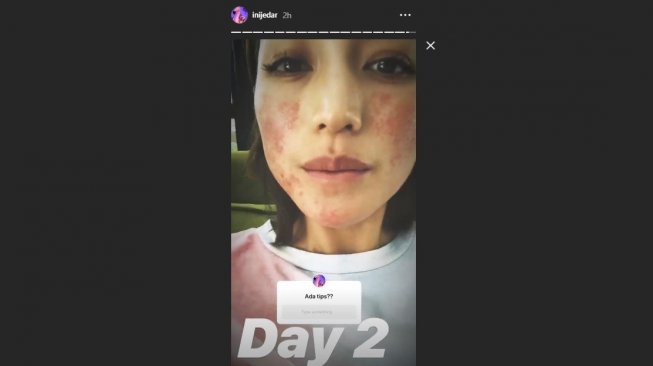 Kondisi wajah Jessica Iskandar yang alergi pasca anestesi(Instagram/@inijedar)