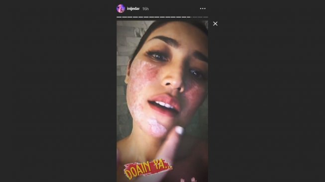 Jessica Iskandar alergi pasca anestesi (Instagram/@inijedar)