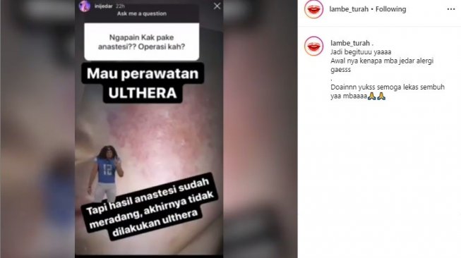 Jessica Iskandar alergi anestesi ketika perawatan ulthera (Instagram/@inijedar)