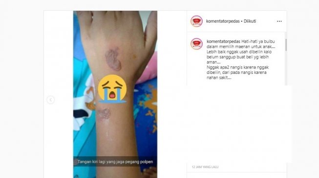 Tangan terbakar akibat penggunaan smartwatch (Instagram/komentarpedas)