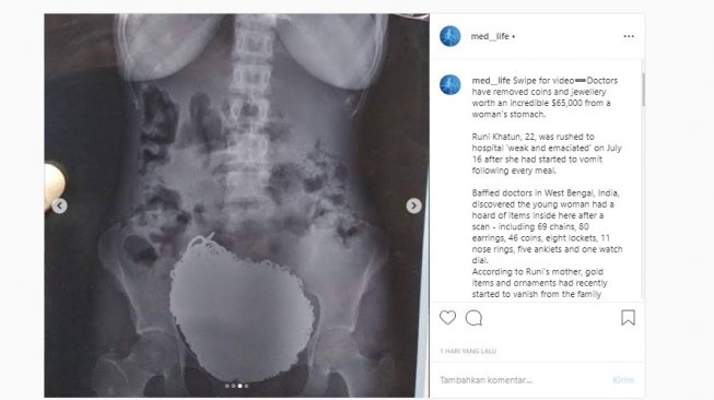 CT Scan perut Runi Khatun (Instagram/med_life)