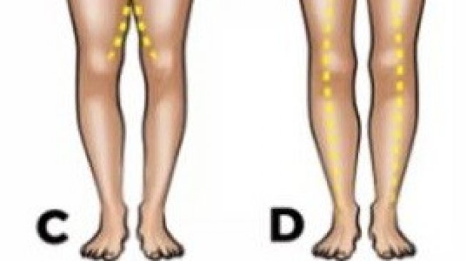 Bentuk kaki gambarkan kepribadian. (Dok Buzzquiz)