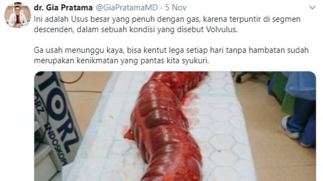 Usus bengkak karena volvulus yang menyebabkan tidak bisa kentut (Twitter/@GiaPratamaMD)
