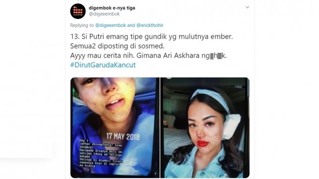Puteri Novita lakukan operasi plastik hidung (Twitter/@digeeembok)