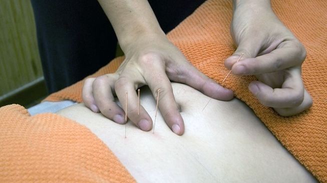Akupunktur Medis Bisa Tingkatkan Peluang Kehamilan Bagi Pasutri yang Belum Punya Momongan