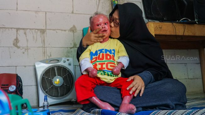 sindrom langka Kelainan Genetik Langka Tubuh Ridho Ganti Kulit Hampir 