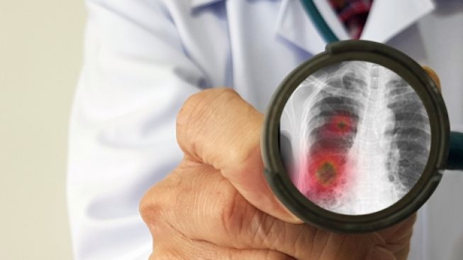 Ilustrasi virus dan bakteri yang menginfeksi paru-paru. (Shutterstock)