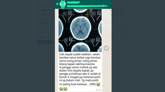 Hasil scan otak. [Twitter/@blogdokter)