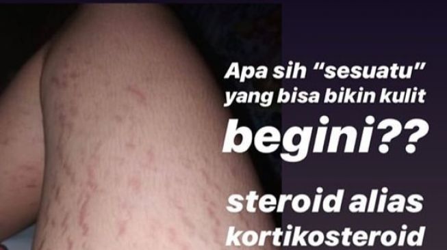 Akibat lotion pemutih abal-abal. (Instagram/@drmita.spkk)