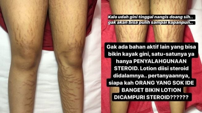 Akibat lotion pemutih abal-abal. (Instagram/@drmita.spkk)