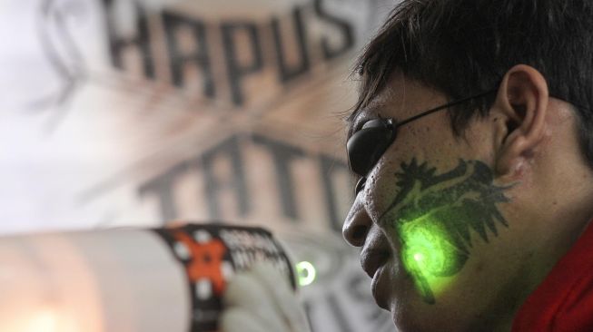 Amankah Menghapus Tato dengan Laser, Ini Penjelasan dari Dokter