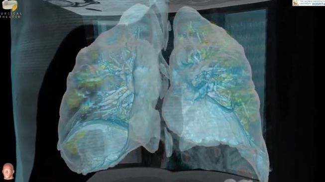 Cuplikan foto dari video 3D paru-paru pasien Covid-19 di Amerika Serikat. [Youtube/Surgical Theater]