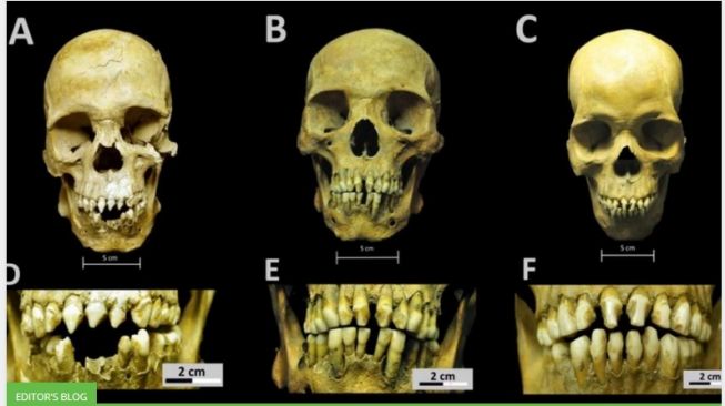 Tiga kerangka individual dari perdagangan budak Afrika ke daratan Amerika [Foto Dok. Rumah Sakit Royal San José de los Naturales, Laboratorium Osteologi, Mexico City, diabadikan oleh R. Barquera dan N. Bernal].