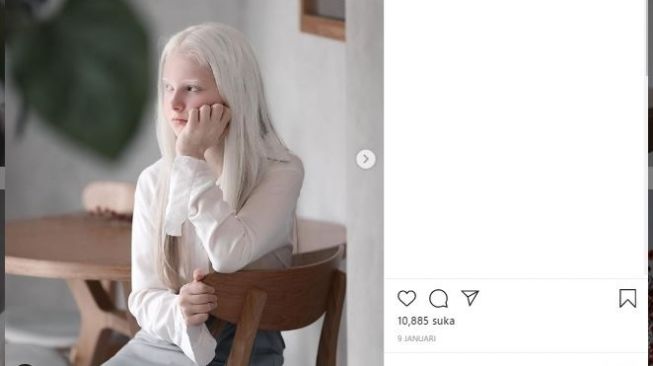 Perhatikan Warna Mata Gadis Albino Ini, Berbeda dari Lahir