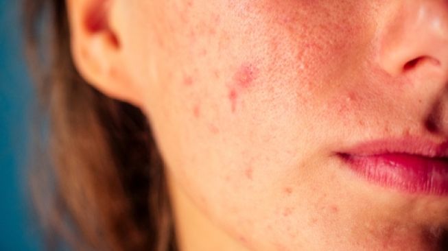 Ilustrasi rosacea, kulit wajah kemerahan (Shutterstock)