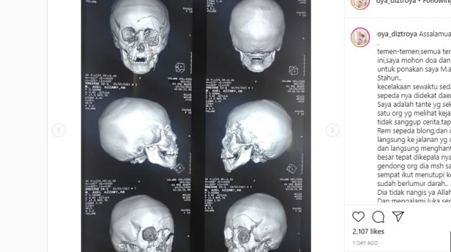 Hasil CT Scan dan MRI M. Axel Azammy. (Instagram/oya_diztroya)