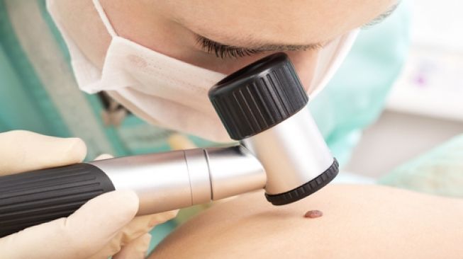 Ilustrasi pemeriksaan kanker kulit. (Shutterstock)