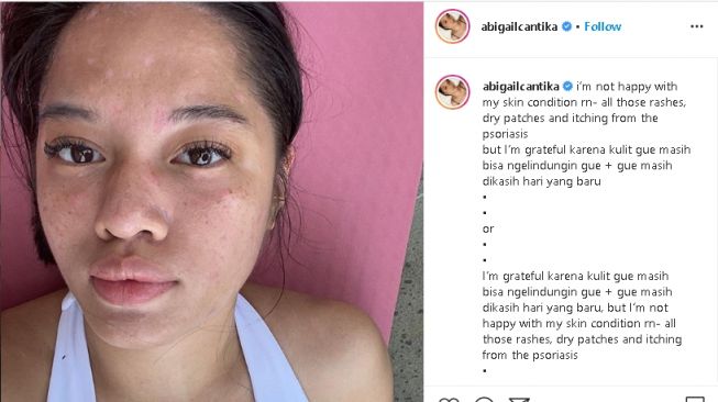 Punya Kulit Bersisik Ini 5 Artis Yang Pernah Alami Psoriasis