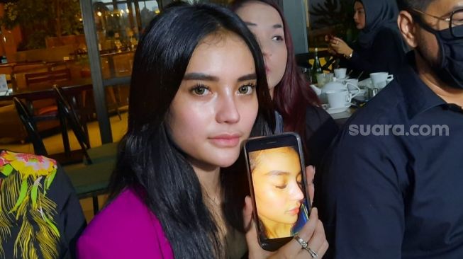 Nabila Aprilia menunjukkan bekas luka yang diduga dilakukan Hana Hanifah. [Ismail/Suara.com]