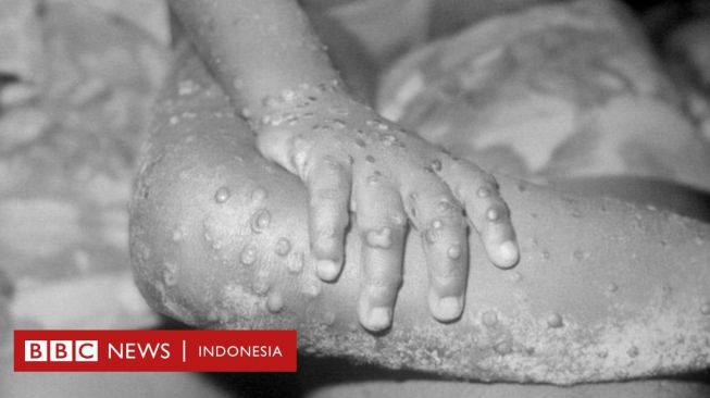 Penyakit Cacar Diberantas dalam  200 Tahun, Bagaimana dengan Covid-19?