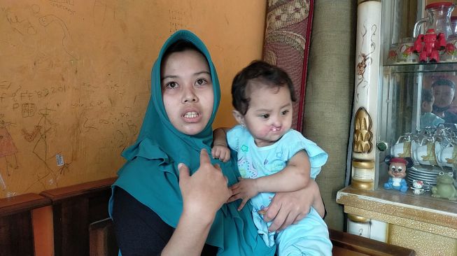 Bayi Salsa di Bogor Diserang Penyakit Langka, Bibirnya 'Hilang' Terkikis