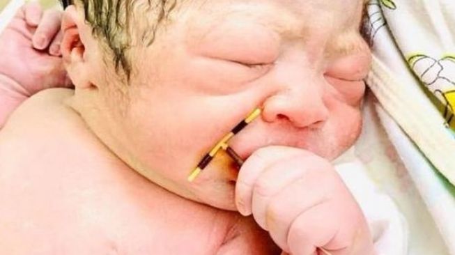Bayi lahir sambil pegang alat kontrasepsi ibunya. (Twitter)