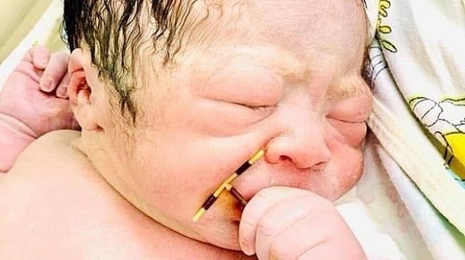 Bayi Ini Keluar dari Rahim Ibunya Sambil Pegang Alat Kontrasepsi