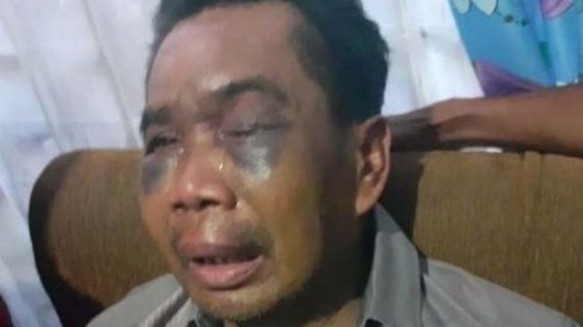 Kondisi Terkini Sarpan, Kuli Bangunan yang Disiksa Polisi Sumut di Tahanan