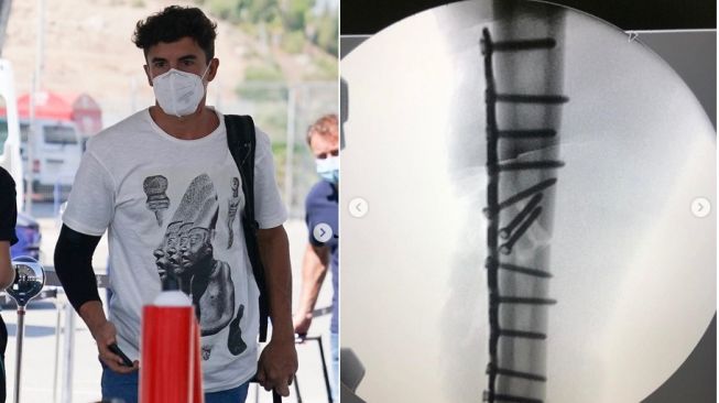 Marc Marquez pamer foto X-Ray patah tulang miliknya (Instagram)