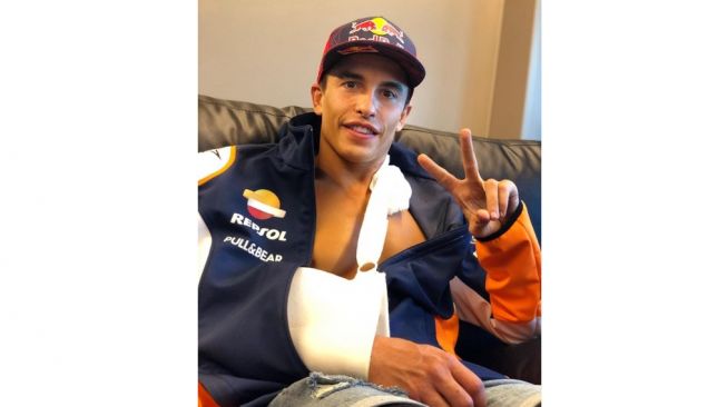 Marc Marquez cedera patah tulang (Instagram)