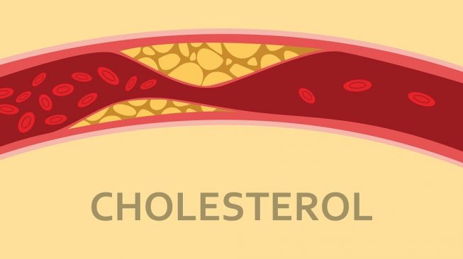 Ilustrasi kolesterol tinggi. (Shutterstock)